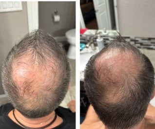 OPTI Hair Growth and Grey Prevention System
